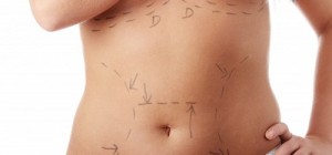 liposuccion abdominoplastie